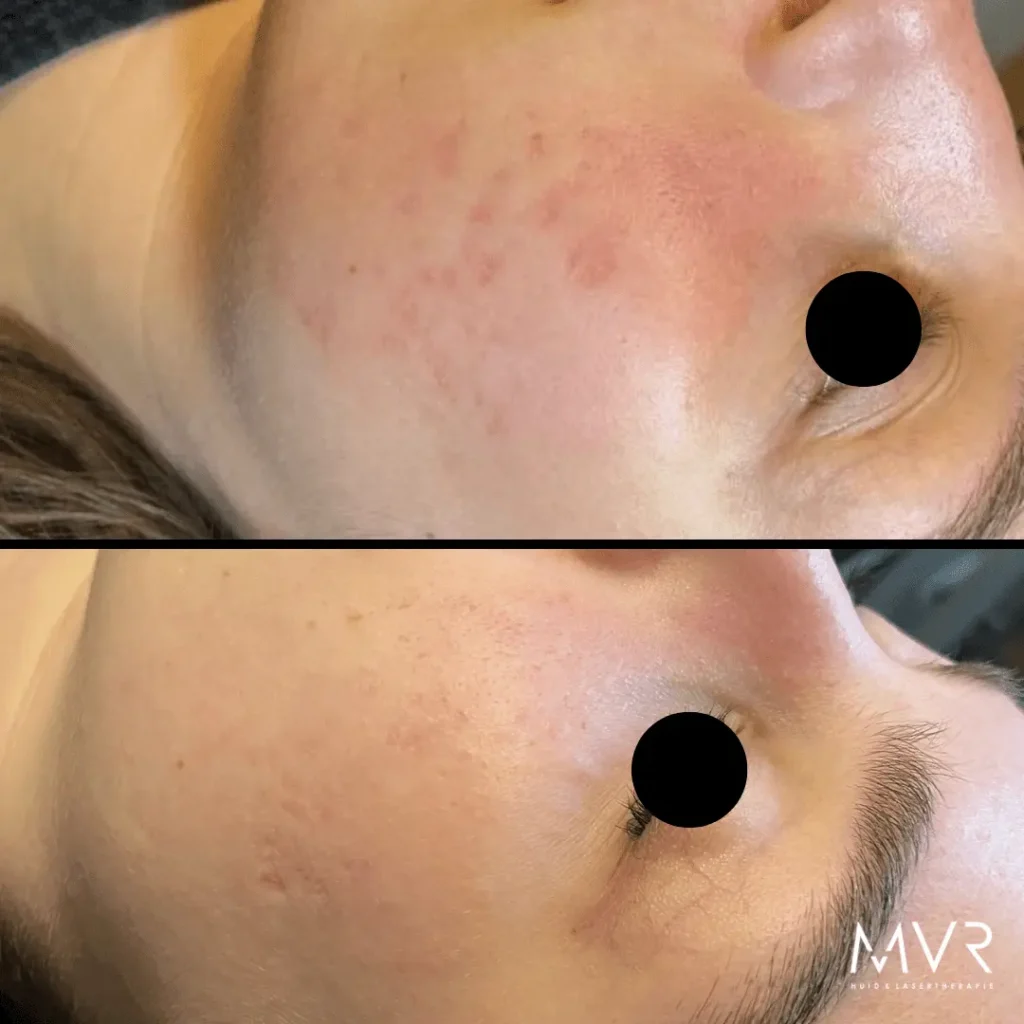 Voor en na resultaat van behandeling van acnelittekens bij MVR Huid- en Lasertherapie in Boxmeer