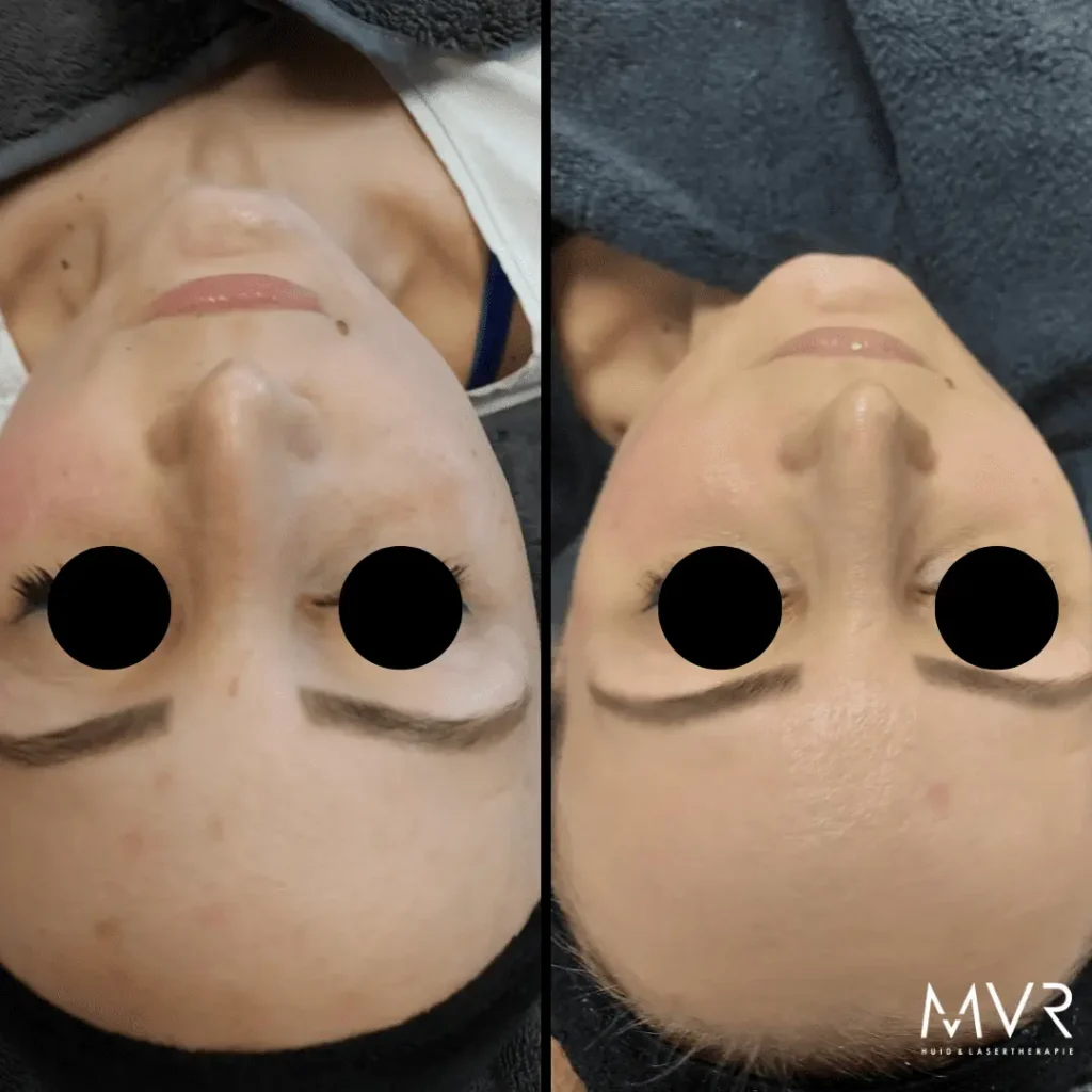 Voor en na resultaat van pigmentbehandeling bijMVR Huid- en Lasertherapie in Boxmeer
